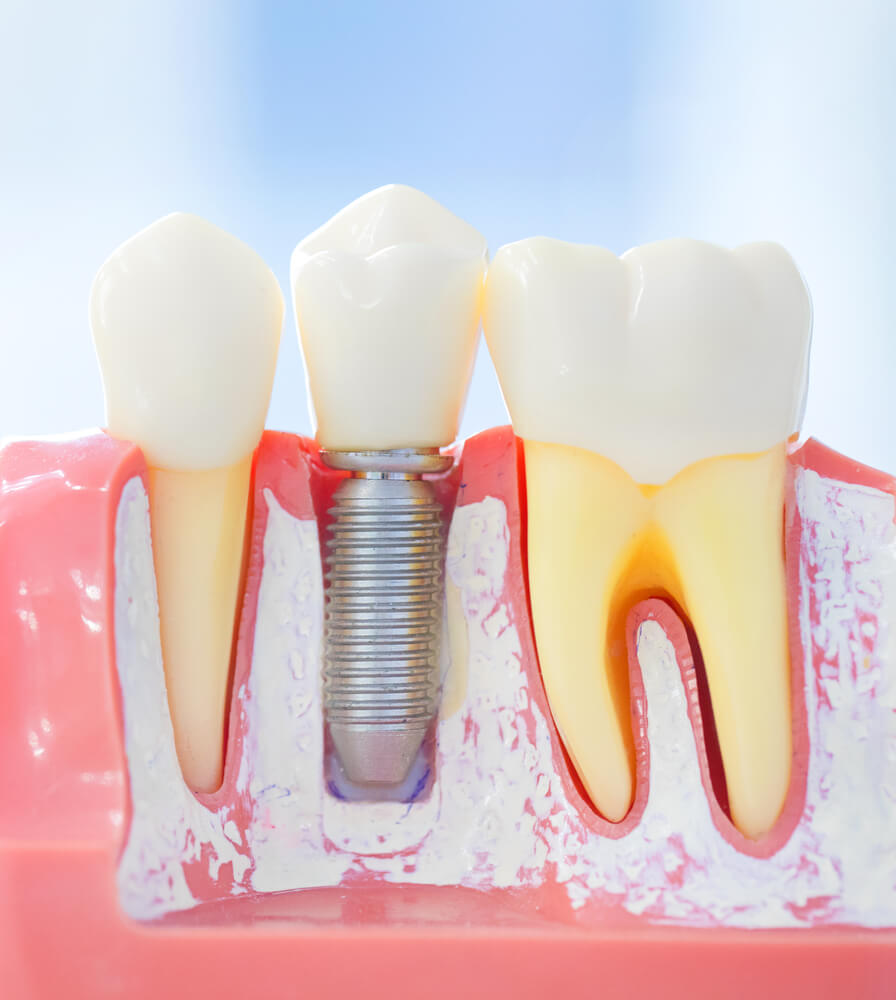 implant zębowy i zdrowe zęby