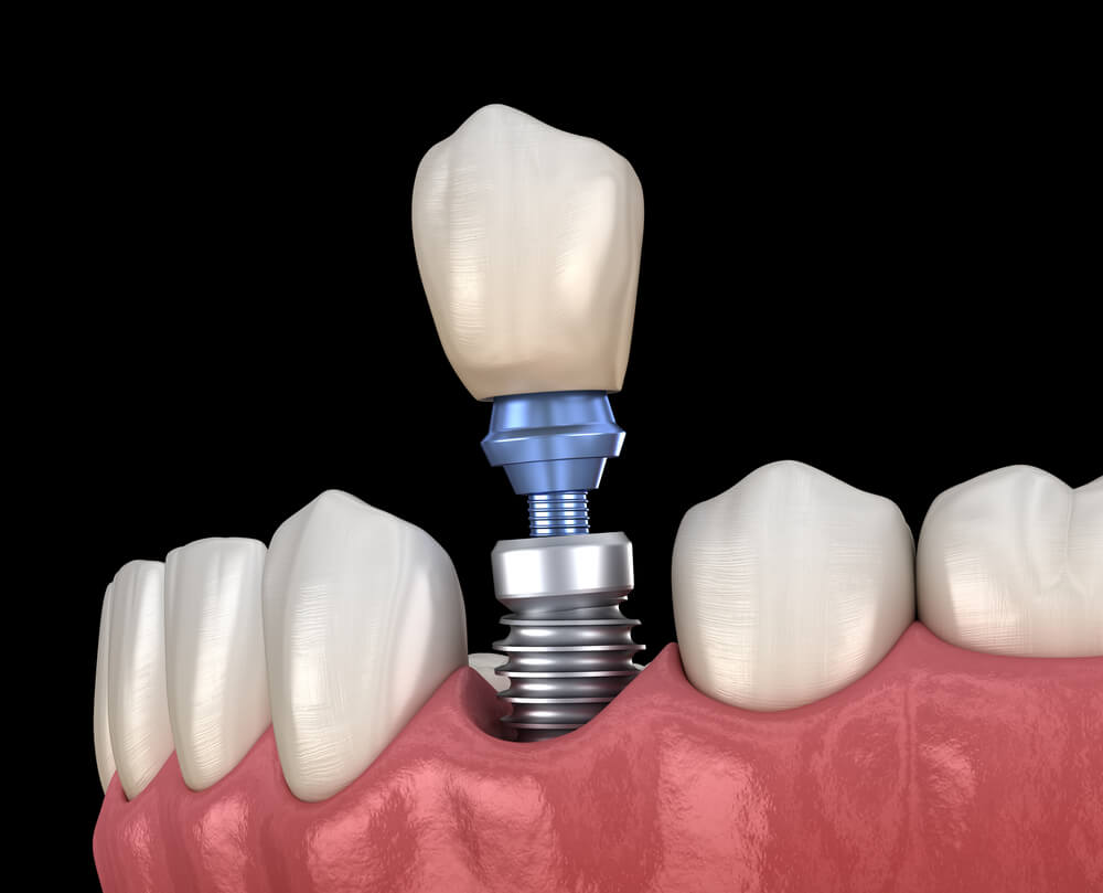 implant zęba - budowa