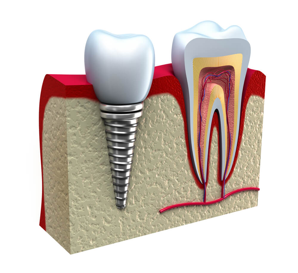 implant zęba w szczęce